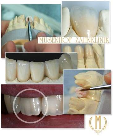 Протезирование зубов в клинике Музенхоф - Дайдесхайм