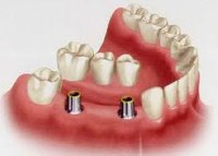 Протезирование двух и более зубов