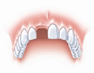 Протезирование одного зуба