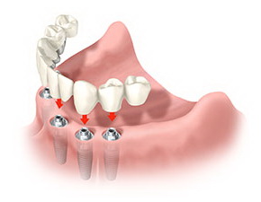 Крестальная имплантация всех зубов челюсти