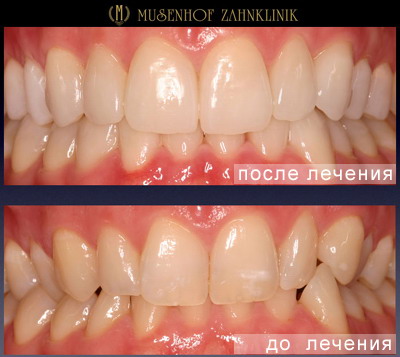 Протезирование зубов в клинике Музенхоф - Дайдесхайм