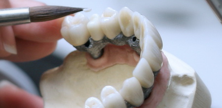 Протезирование зубов в Германии